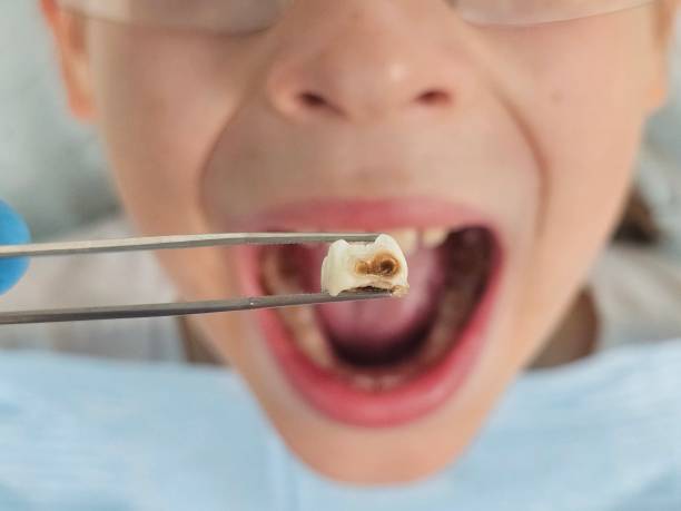 Best Emergency Treatment for Toothache in Combe, LA